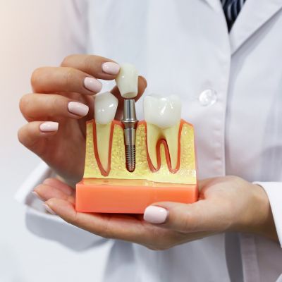 Custom abutment emergence profile example