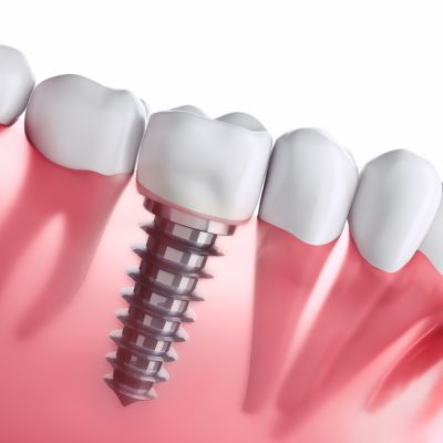 Custom abutment emergence profile example