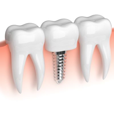 Custom abutment emergence profile example