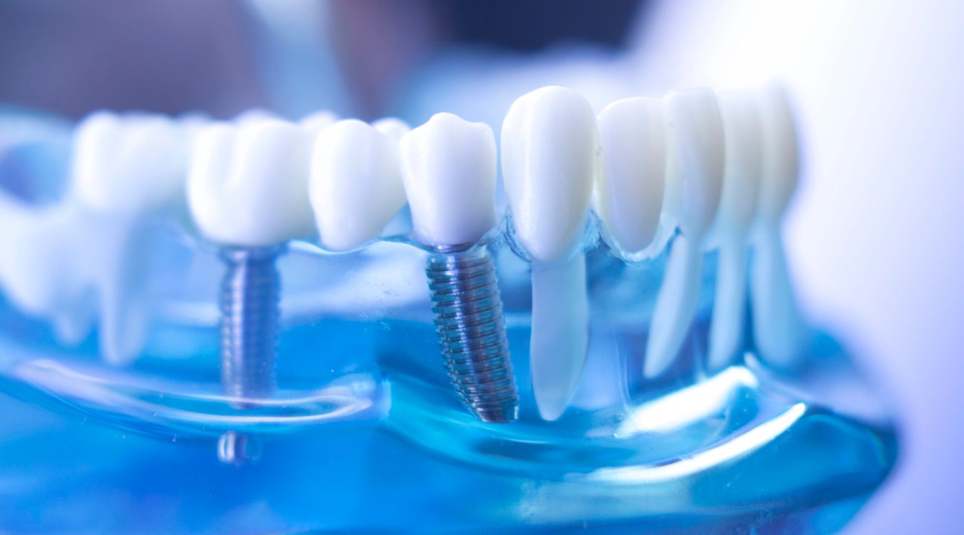 Dentium dental implants