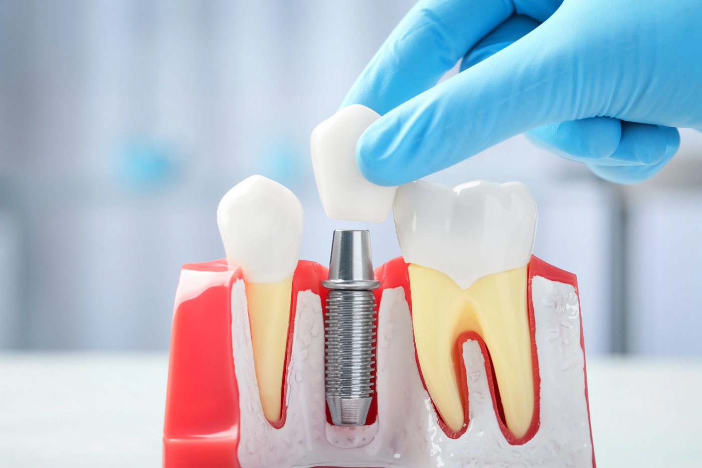 Dentium prosthetic components